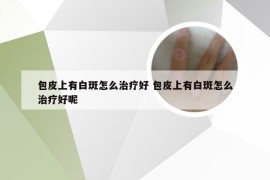 包皮上有白斑怎么治疗好 包皮上有白斑怎么治疗好呢