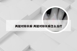 两腿对称长癣 两腿对称长癣怎么治疗