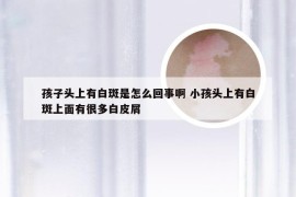 孩子头上有白斑是怎么回事啊 小孩头上有白斑上面有很多白皮屑