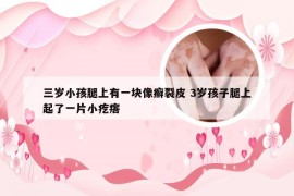 三岁小孩腿上有一块像癣裂皮 3岁孩子腿上起了一片小疙瘩