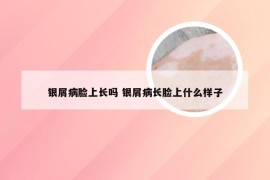 银屑病脸上长吗 银屑病长脸上什么样子