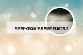 银屑病马来西亚 银屑病国外的治疗方法