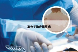 准分子治疗银屑病