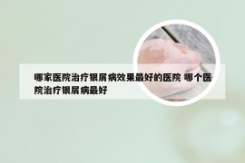 哪家医院治疗银屑病效果最好的医院 哪个医院治疗银屑病最好