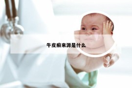 牛皮癣来源是什么