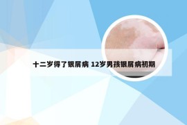 十二岁得了银屑病 12岁男孩银屑病初期