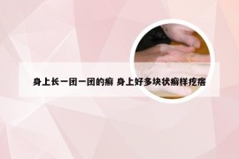 身上长一团一团的癣 身上好多块状癣样疙瘩