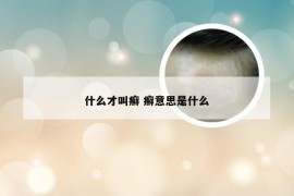 什么才叫癣 癣意思是什么