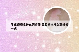 牛皮癣癣吃什么药好使 屁股癣吃什么药好使一点