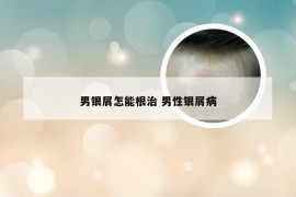 男银屑怎能根治 男性银屑病