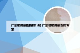 广东银屑病医院排行榜 广东省银屑病首席专家