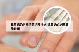 银屑病的护理问题护理措施 银屑病的护理措施诊断