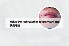 衡水哪个医院治皮肤病好 衡水哪个医院治皮肤病好些