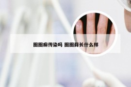 圈圈癣传染吗 圈圈藓长什么样