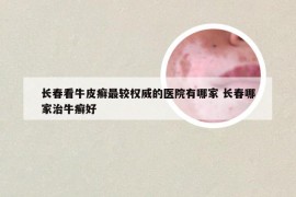 长春看牛皮癣最较权威的医院有哪家 长春哪家治牛癣好