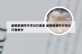 副银屑病可不可以打激素 副银屑病可不可以打激素针