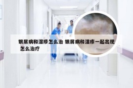 银屑病和湿疹怎么治 银屑病和湿疹一起出现 怎么治疗