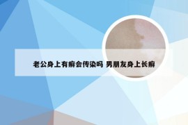 老公身上有癣会传染吗 男朋友身上长癣