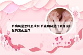 白癜风是怎样形成的 白点癫风是什么原因引起的怎么治疗