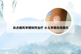 白点癫风早期如何治疗 小儿早期白斑图片