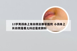 13岁男孩身上有白斑去那家医院 小孩身上长白斑是看儿科还是皮肤科