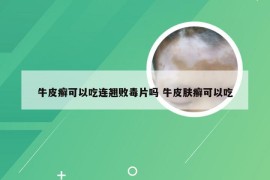 牛皮癣可以吃连翘败毒片吗 牛皮肤癣可以吃