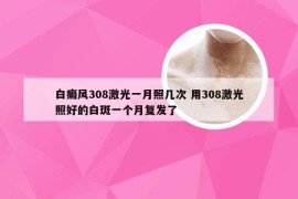 白癜风308激光一月照几次 用308激光照好的白斑一个月复发了