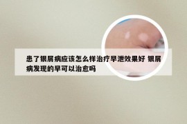 患了银屑病应该怎么样治疗早泄效果好 银屑病发现的早可以治愈吗