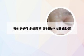 开封治疗牛皮癣医院 开封治疗皮肤病位置