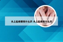 头上起癣要擦什么药 头上起癣用什么药