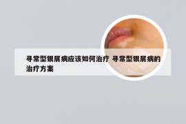 寻常型银屑病应该如何治疗 寻常型银屑病的治疗方案