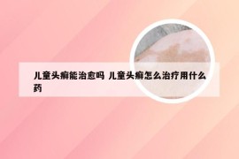 儿童头癣能治愈吗 儿童头癣怎么治疗用什么药