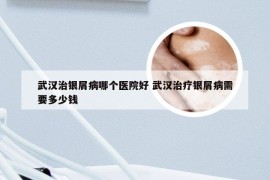 武汉治银屑病哪个医院好 武汉治疗银屑病需要多少钱