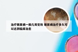 治疗银屑病一般几周见效 银屑病治疗多久可以达到临床治愈