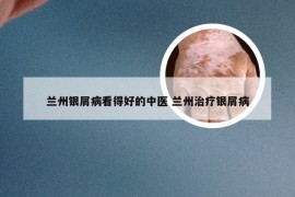 兰州银屑病看得好的中医 兰州治疗银屑病