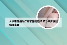 长沙银屑病治疗哪家医院能好 长沙银屑皮肤病哪家强