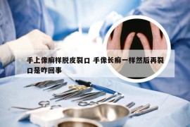 手上像癣样脱皮裂口 手像长癣一样然后再裂口是咋回事