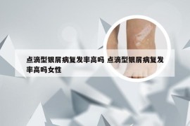 点滴型银屑病复发率高吗 点滴型银屑病复发率高吗女性