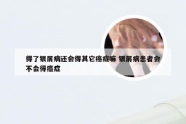 得了银屑病还会得其它癌症嘛 银屑病患者会不会得癌症