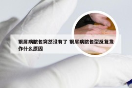 银屑病脓包突然没有了 银屑病脓包型反复发作什么原因