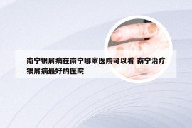 南宁银屑病在南宁哪家医院可以看 南宁治疗银屑病最好的医院