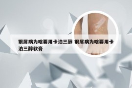 银屑病为啥要用卡泊三醇 银屑病为啥要用卡泊三醇软膏