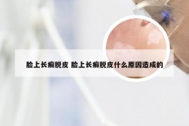 脸上长癣脱皮 脸上长癣脱皮什么原因造成的