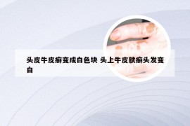 头皮牛皮癣变成白色块 头上牛皮肤癣头发变白