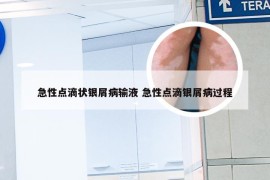 急性点滴状银屑病输液 急性点滴银屑病过程