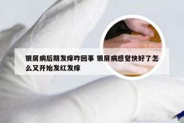 银屑病后期发痒咋回事 银屑病感觉快好了怎么又开始发红发痒