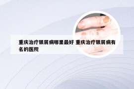 重庆治疗银屑病哪里最好 重庆治疗银屑病有名的医院