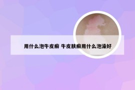 用什么泡牛皮癣 牛皮肤癣用什么泡澡好