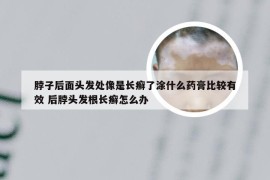 脖子后面头发处像是长癣了涂什么药膏比较有效 后脖头发根长癣怎么办