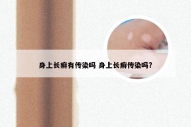 身上长癣有传染吗 身上长癣传染吗?